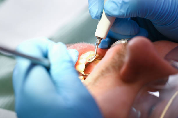 Best Emergency Wisdom Tooth Extraction in Tabor City, NC